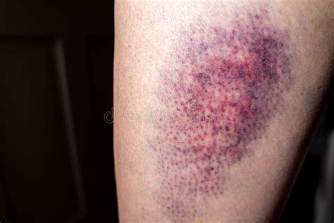 Bruise On Upper Thigh