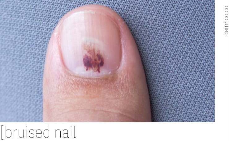 Bruised Nail Trauma Nail Care Treatment Edmonton Ab