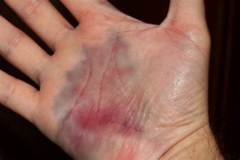 Bruised Palm Of Hand