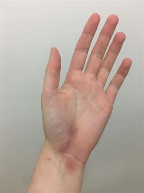 Bruised Palm Treatment Guide