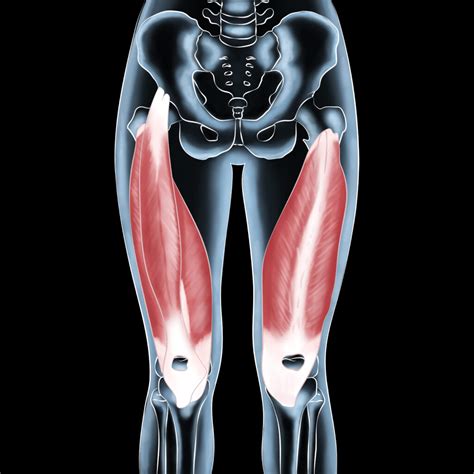 Bruised Quadricep Muscle