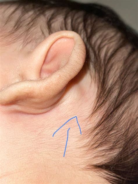 Bump Behind Baby's Ear: Identify Causes