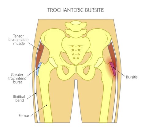 Bursitis Hip, Trochanteric, Knee, Shoulder, Elbow Causes, 58% Off