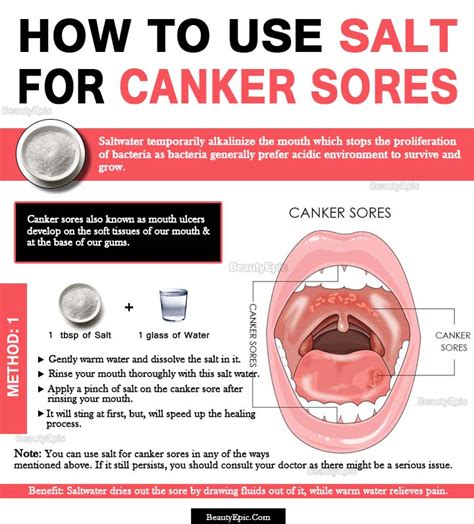 Canker Sore Cure: Salt Water Remedies Explained