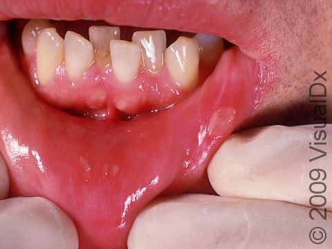 Canker Sore On Lip Causes Risk Factors And Treatment