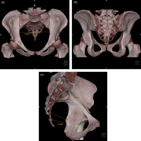 Cephalopelvic Disproportion Diagnosis