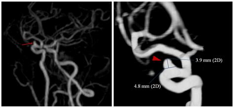 Cerebral Aneurysm Angiogram