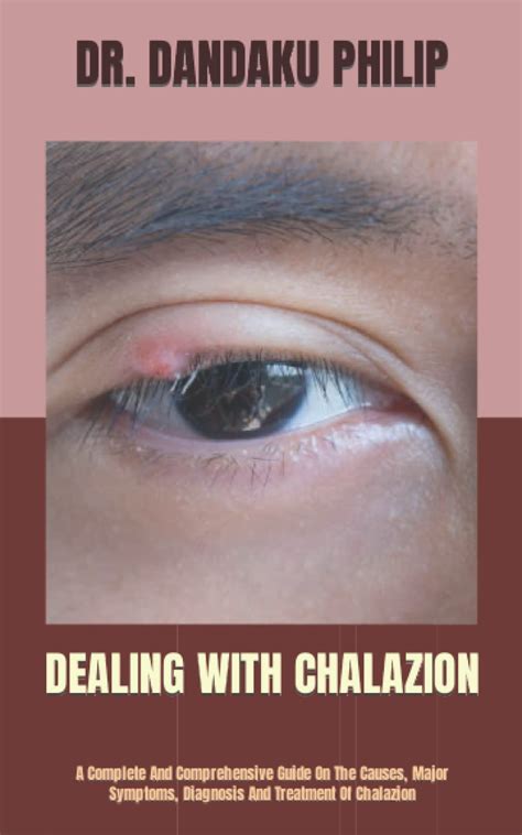 Chalazion Treatment Guide