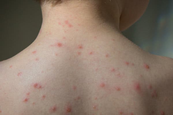 Chickenpox Vaccine Voices For Vaccines