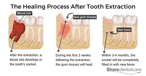 Civiliza O Subtropical Corredor Bone Healing After Tooth Extraction