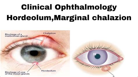 Clinical Ophthalmology Chalazion In Easiest Way Youtube