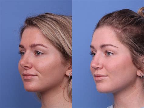 Closed Rhinoplasty Before And After Rhinoplasty 1 Year After Surgery