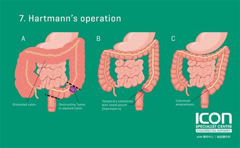 Colorectal Resection Colectomy Icon Specialist Centre