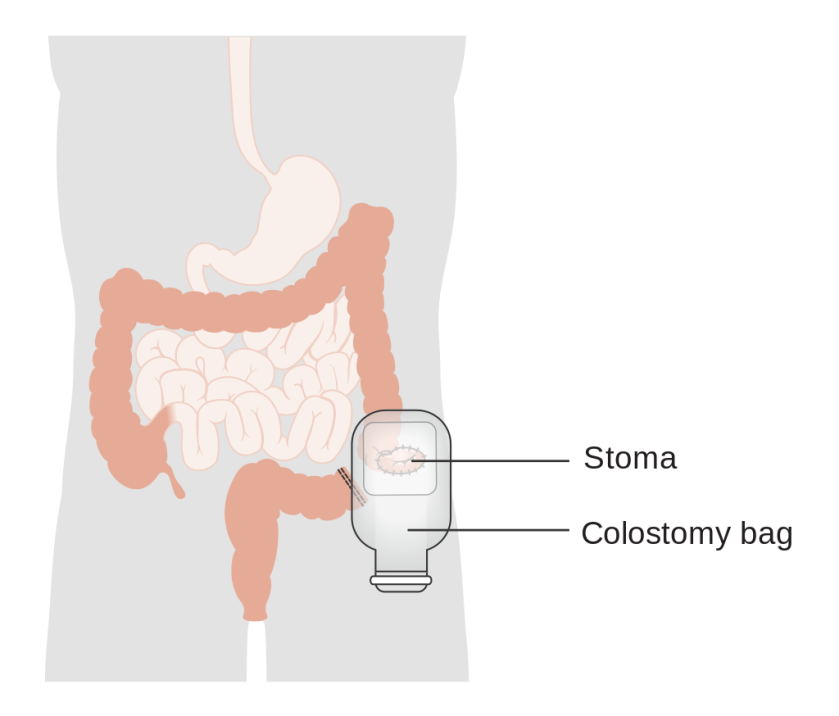 Colostomy Diagram