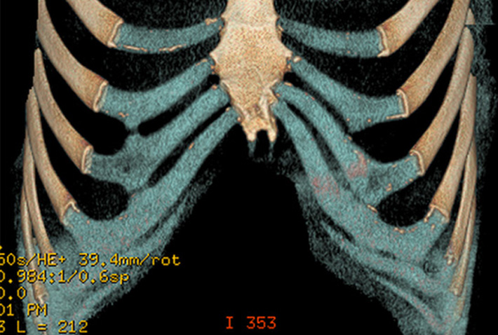 Complex Chest Wall Injury Rib Injury Clinic