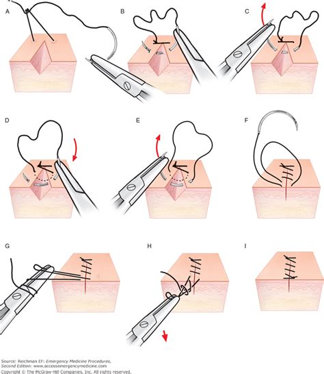 Complex Facial Laceration With Suture Repair