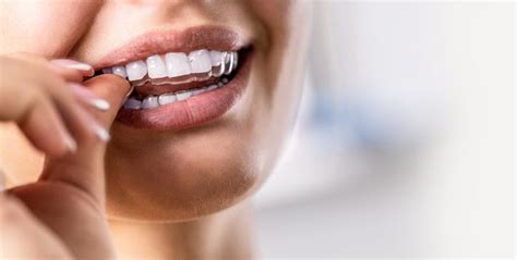 Compliance Tips For Invisalign Flower Mound Tx Orthodontist