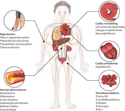 Complications Of Cushing S Syndrome State Of The Art The Lancet