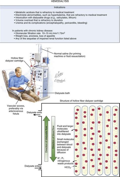 Continuous Renal Replacement Therapy Anesthesia Key