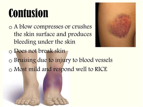 Contusion Definition