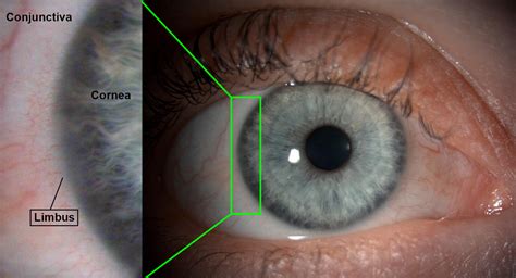 Cornea Gene Vision