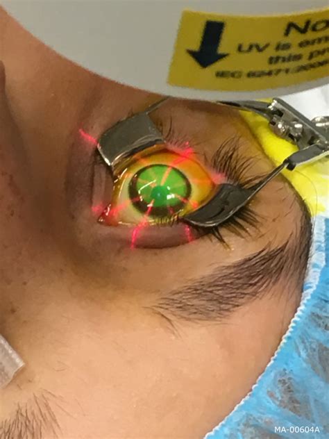 Corneal Collagen Cross Linking Treatment In Dc Md Keratoconus