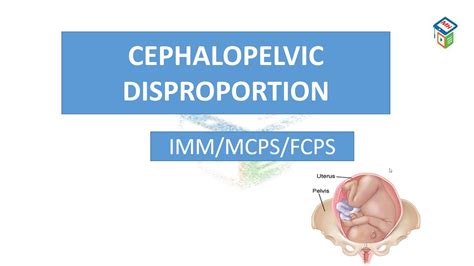 Cpd Cephalopelvic Disproportion Cpsp Format Mcqs Labour Module