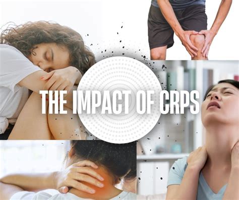 Crps Life Expectancy Facts: Know Your Prognosis