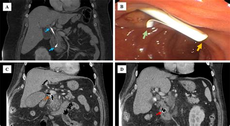 Ct Imaging Features Of Bile Duct Stent Complications Clinical Imaging