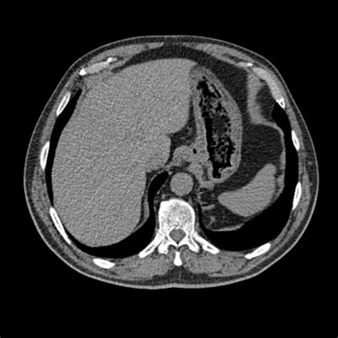 Ct Scan Abdomen