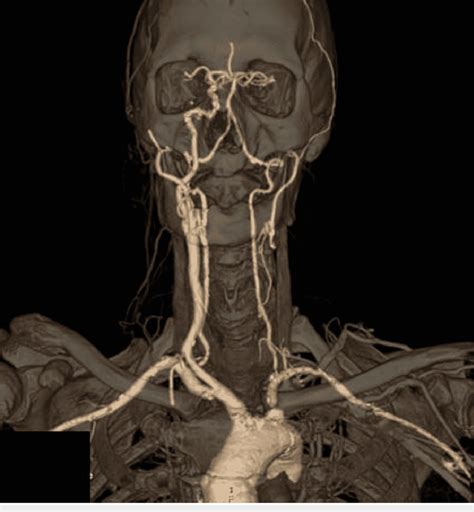 Cta Head And Neck