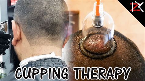 Cupping For Migraine Relief Found