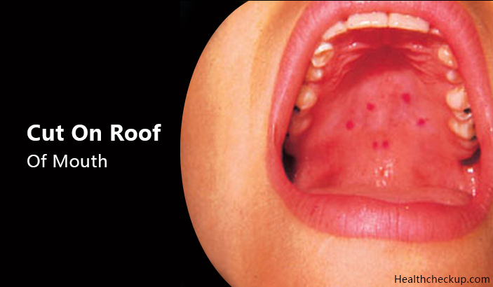 Cut Roof Of Mouth