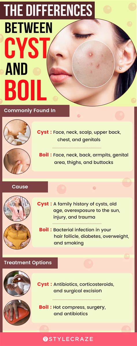 Cyst Vs Pimple What S The Difference And How To Treat Them