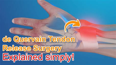 De Quervain Amp 39 S Tendon Release