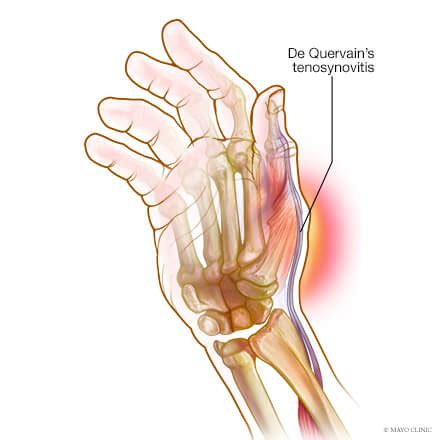 De Quervain Amp 39 S Tenosynovitis Thumb Pain Amp Painful Wrist