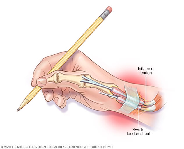 De Quervain Syndrome Causes Symptoms Diagnosis Treatment Exercises