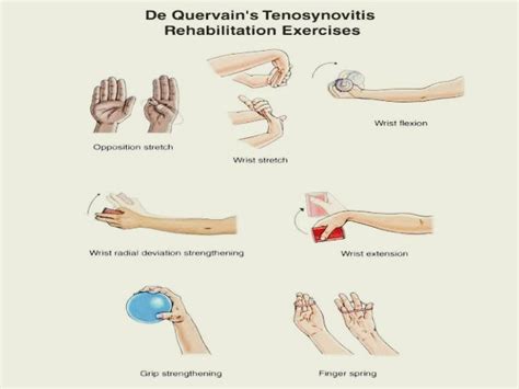 De Quervain Syndrome Exercises