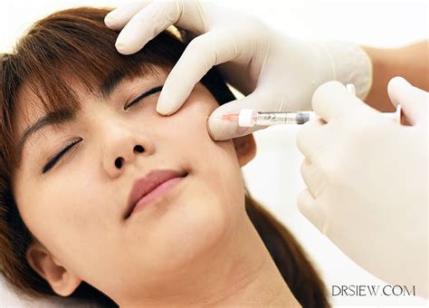 Dermal Fillers 10 Important Things You Need To Know Dr Siew Com