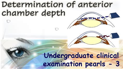 Determination Of Anterior Chamber Depth Undergraduate Clinical