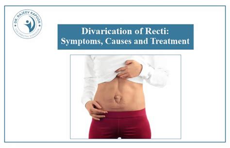 Diastasis Recti (Abdominal Separation): Symptoms Treatment, 53% Off