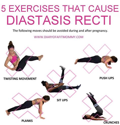 Diastasis Recti Exercises