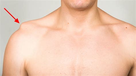 Dislocated Shoulder Causes Signs Symptoms How To Fix