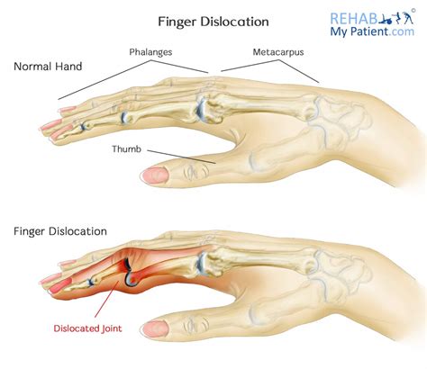 Dislocating Finger Treatment: Fast Relief