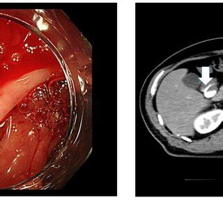 Diverticular Disease And Bleeding