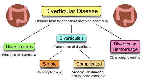 Diverticular Disease: Diverticulitis Vs Diverticulosis, 43% Off