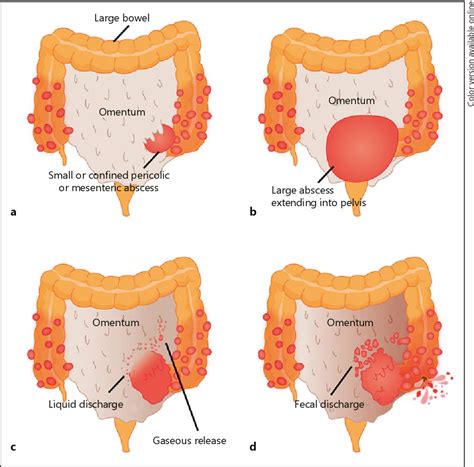 Diverticulosis Bleeding