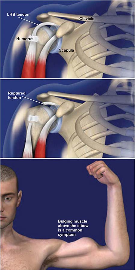 Do Biceps Tendon Tears Require Surgery