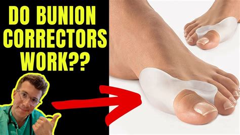 Do Bunion Correctors Work