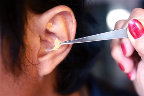 Ear Wax Removal: Effective Athome Solutions